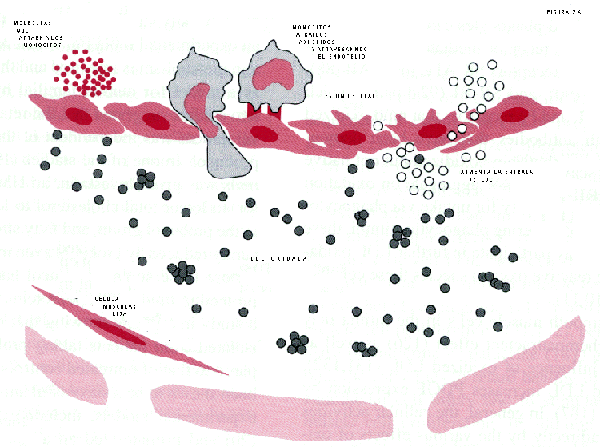 pasos de formación de placa de aterosclerosis