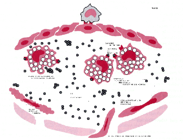 pasos de formación de placa de aterosclerosis